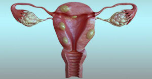 آیا فیبروم باعث سقط جنین میشود 